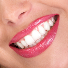 Cary Dentist Teeth Whitening